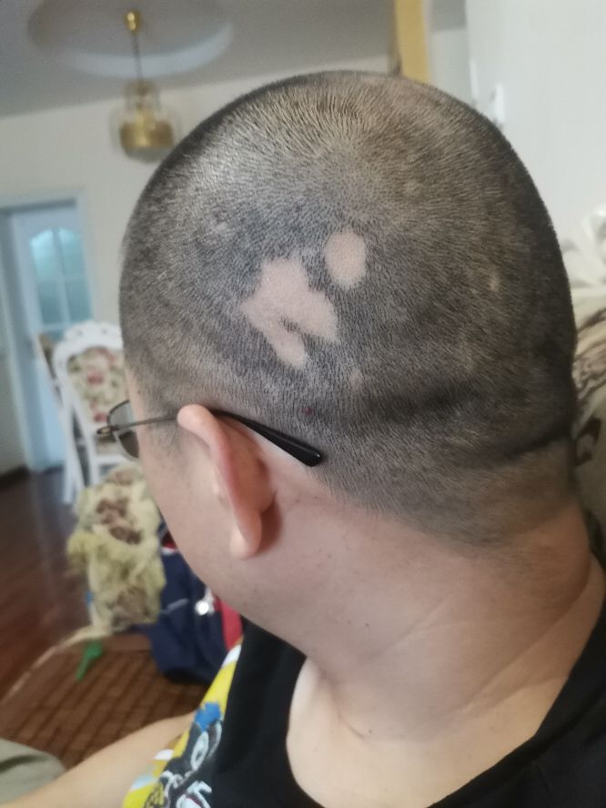 发现斑秃刚好又开始掉头发怎么办,突然发现斑秃怎么治疗