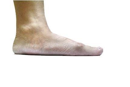 改善足跟疼的鞋垫,改善脚型的鞋垫真的有用吗