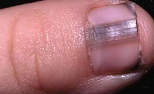 娃指甲上有白点是怎么回事,孩子指甲横纹有白点