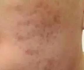 痘印很顽固怎么祛痘印,痘印祛痘药膏