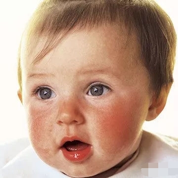 怎么解决冬天宝宝脸部开裂干燥,春季宝宝脸干裂怎么办呢