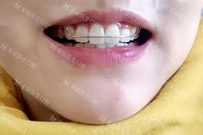 一般矫正牙齿是怎样去矫正的,牙齿矫正的几种牙齿类型和方案