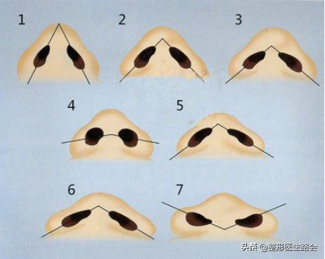 鼻翼缩小鼻骨内推手术,宽鼻头缩窄手术好做吗