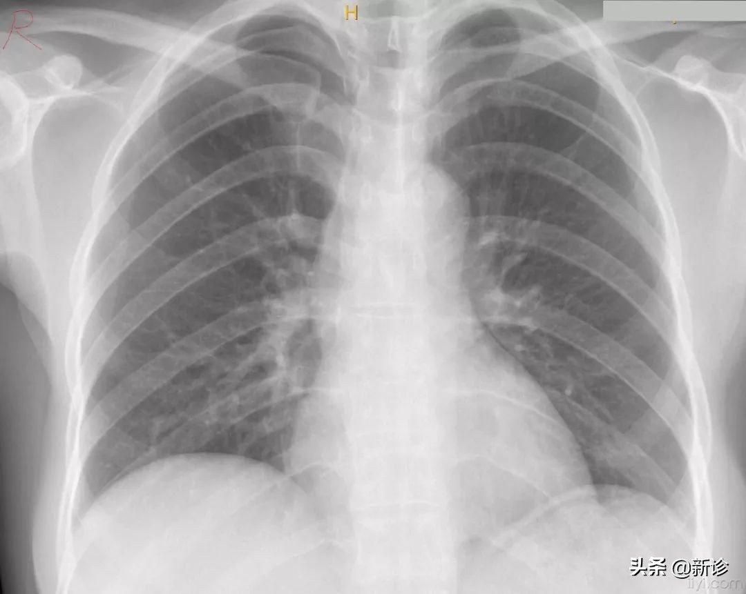 刚怀孕拍了胸片孩子能要吗,体检拍胸片后多久能怀孕