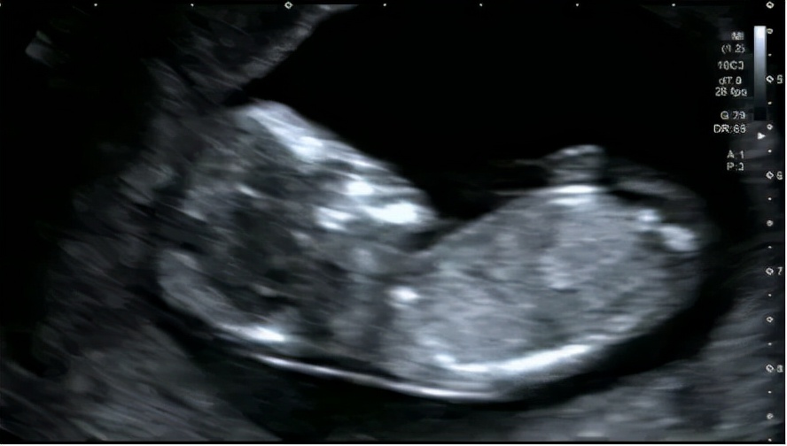 怎么判断胎儿是否颅脑畸形,健康知识胎儿