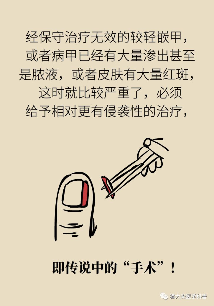 脚趾甲往肉里长怎么治除根,脚趾甲长在肉里面治疗视频