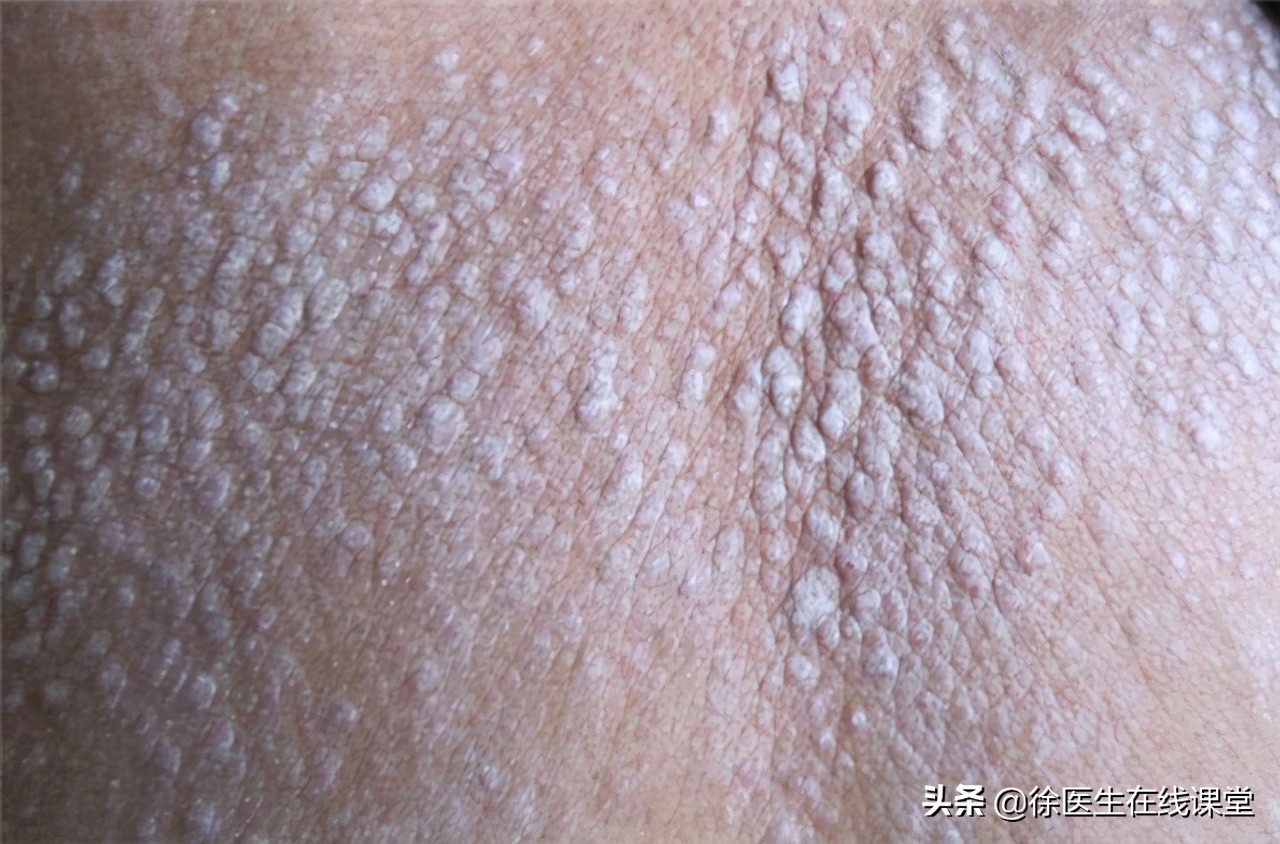 甲硝唑便宜又实用都能搞定哪些病,甲硝唑哪一种见效快图片