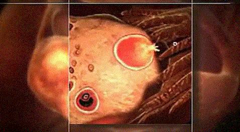 多囊卵巢综合征雄激素高能怀孕吗,多囊卵巢综合征怀孕怎么避免胎停