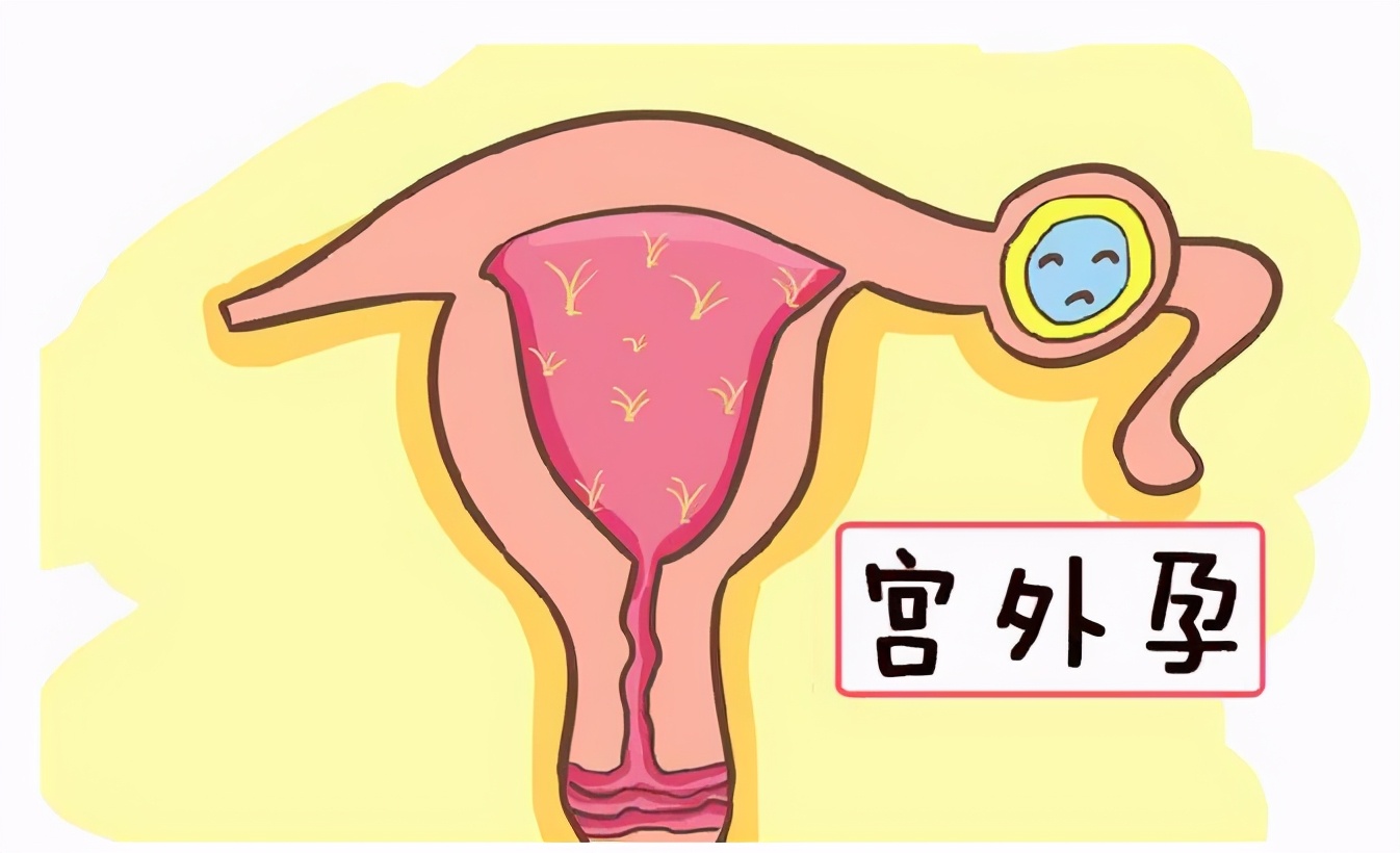 离奇的宫外孕,宫外孕受孕轨迹