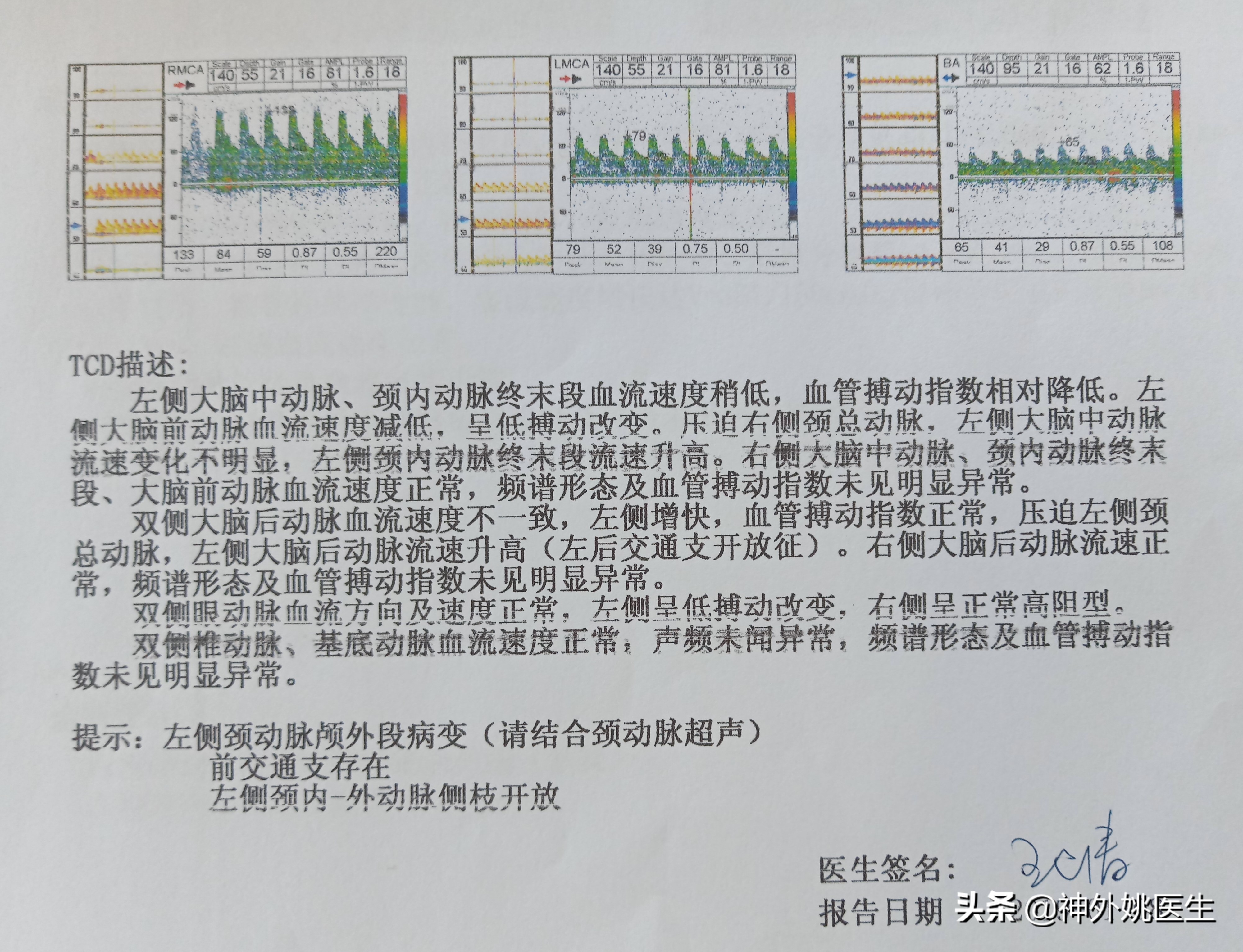 颈动脉狭窄的外科治疗
