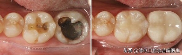 现在修复牙齿有哪几种类型的牙,牙齿修复的几种方法和价格