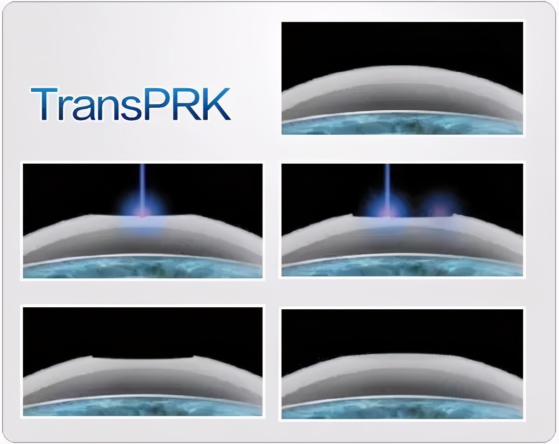 做半飞秒近视眼手术最坏的后果,近视眼手术最佳年龄和度数费用