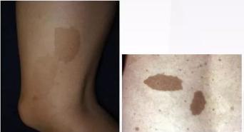 全身内外都是瘤子是什么病,全身长满瘤子怎么治疗