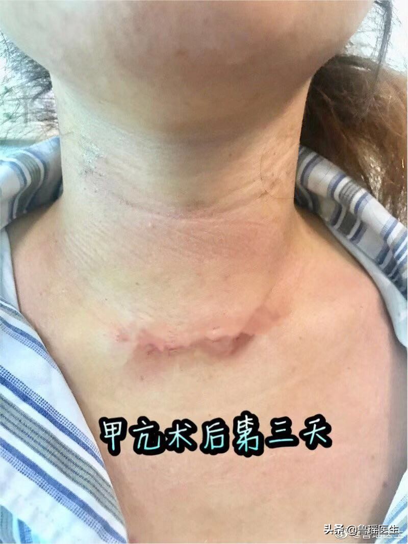 甲亢七年可以做消融吗,甲亢七年