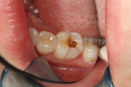 当牙疼遇上生理疼,当牙疼时为什么夜晚比白天更疼