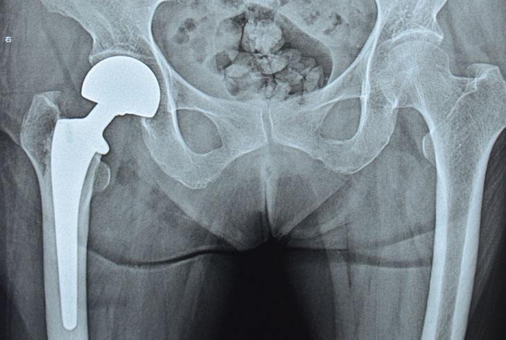 老年人股骨颈骨折建议,80岁老年人股骨颈骨折保守治疗