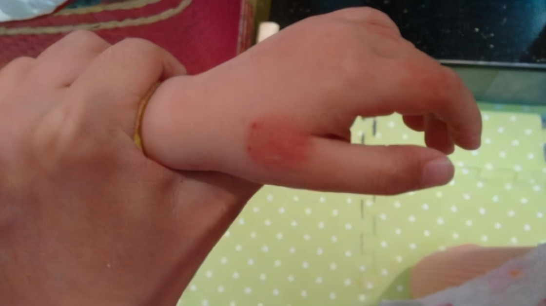 新生儿湿疹怎么预防最佳方法,新生儿怎么预防湿疹最好方法