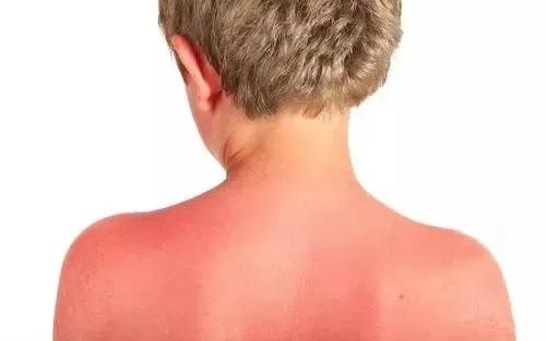 宝宝三岁前晒伤,别等孩子晒黑晒伤才开始涂防晒