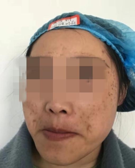 江西南昌荣美会祛斑,美容院祛斑毁容案例