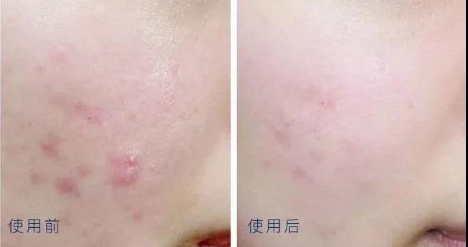 痘肌用什么祛痘膏最好,痘友分享心酸的祛痘之路