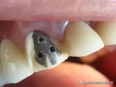 烤瓷牙十几年了有必要更换吗,烤瓷牙套里的牙烂了有什么症状