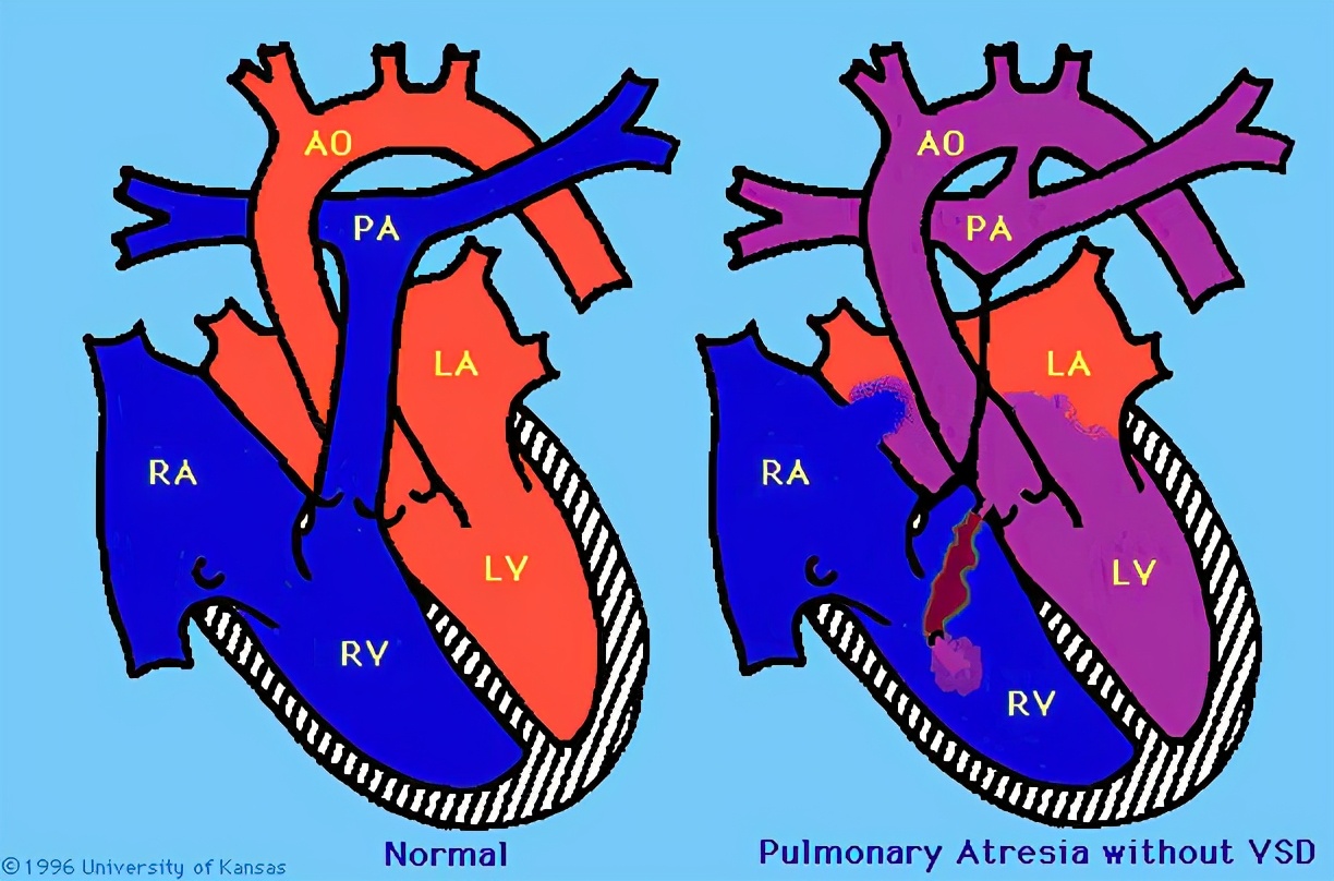 肺动脉闭锁合并室间隔缺损,肺动脉闭锁和法洛四联症哪个严重