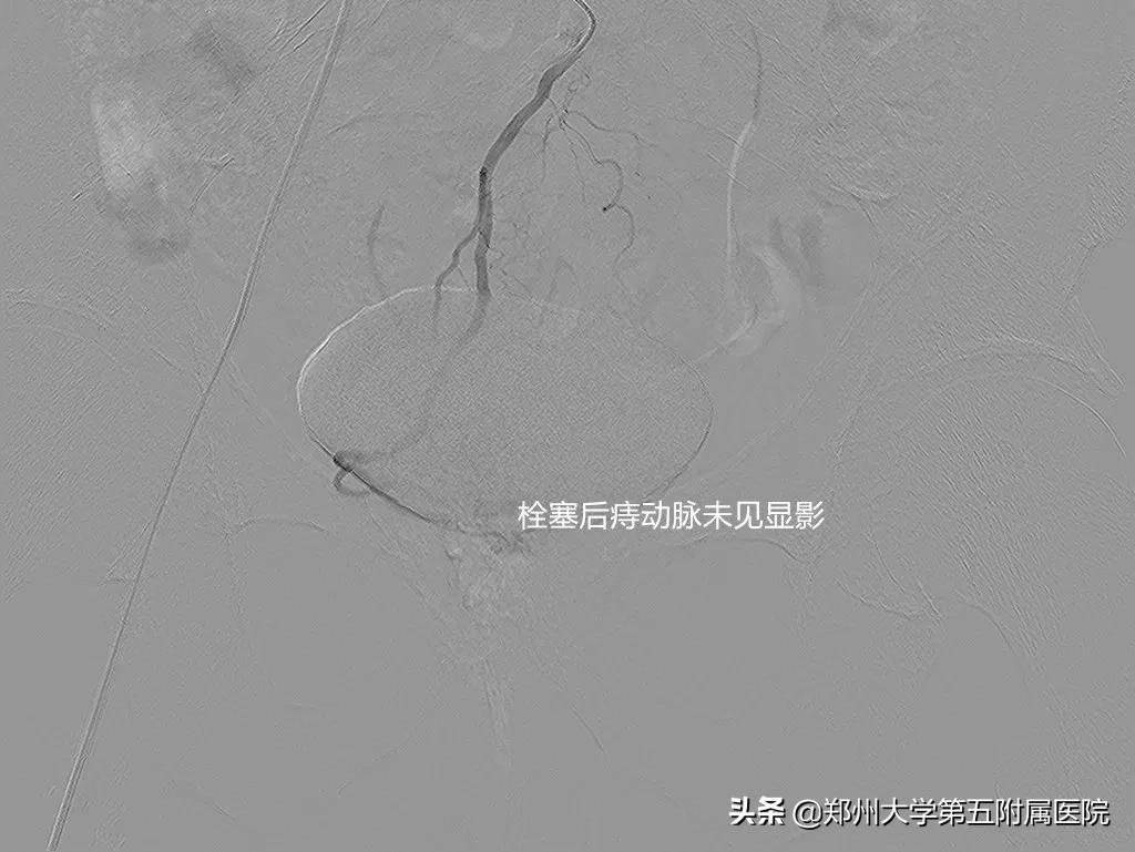 有痔之士的中医护肛妙方,有没有痔疮经过保守治疗不痛苦的