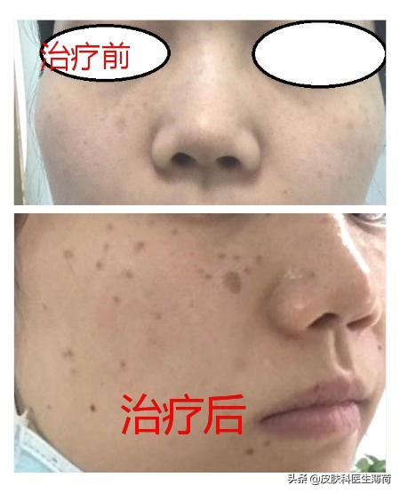 激光祛斑仪雀斑,祛斑祛红色痘印激光