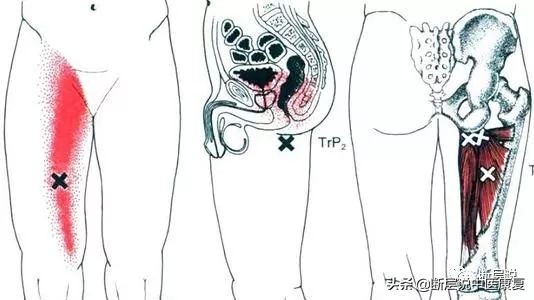 女性盆底健康问题,针刺要扎三阴交,手法要选内收肌