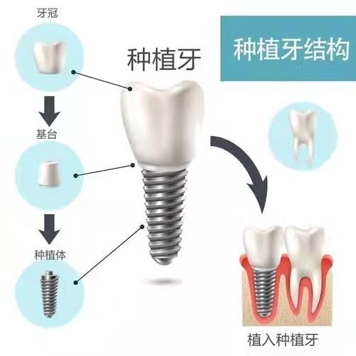 牙齿那些事儿调查表,牙齿科普小知识种植牙