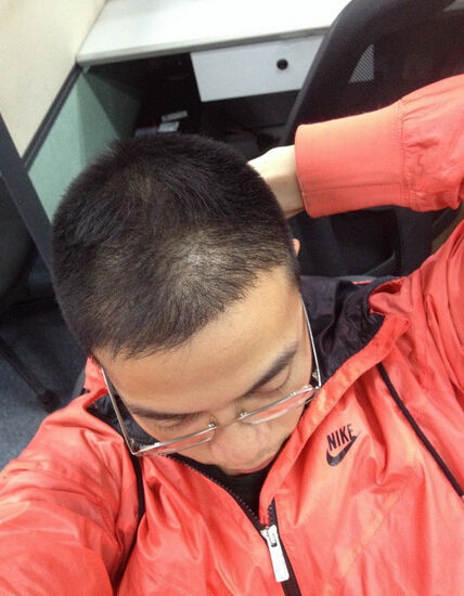 亲身经历脱发怎么治,脱发严重怎么办如何快速治脱发