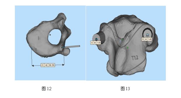 特发性脊柱侧凸的康复治疗方法,先天性脊柱侧凸