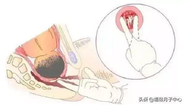 顺产开十指了要自己走进去产房吗,顺产开十指还需要侧切吗