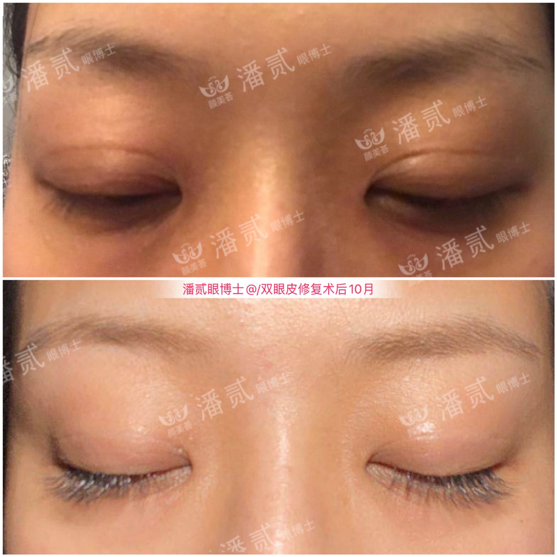 双眼皮失败的女孩,双眼皮失败做成了三眼皮好修复吗