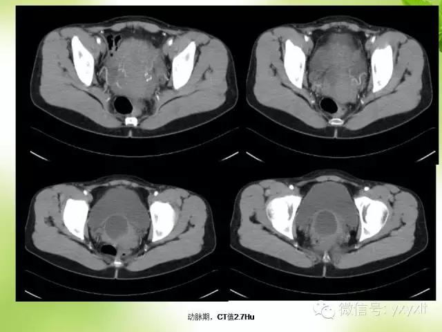 苗勒氏管囊肿在哪里,苗勒氏管囊肿是指什么