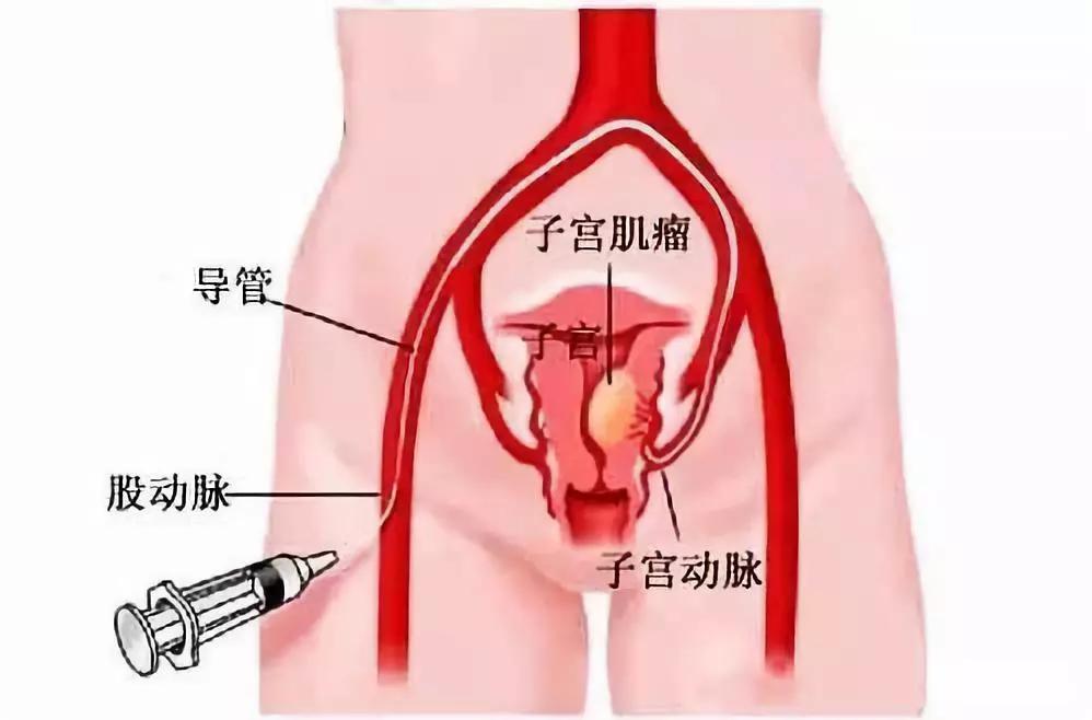 专家讲治疗子宫肌瘤的方法,微创介入子宫肌瘤栓塞术