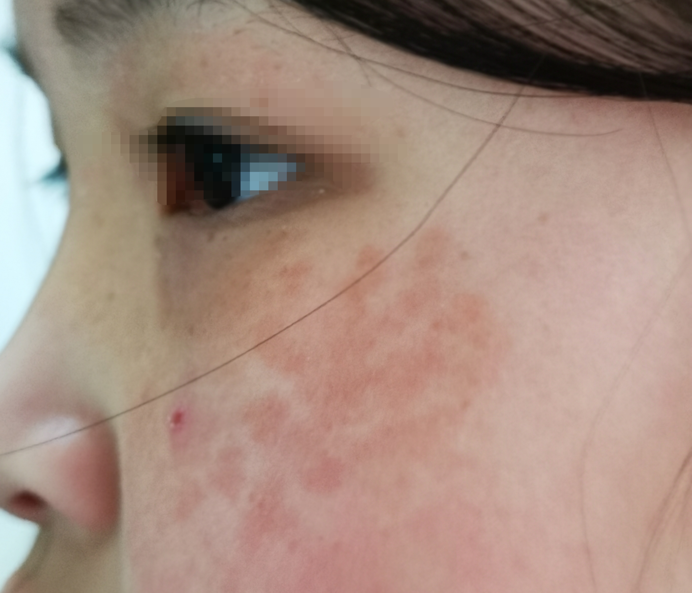 冬季护肤之祛斑正当时——光电治疗