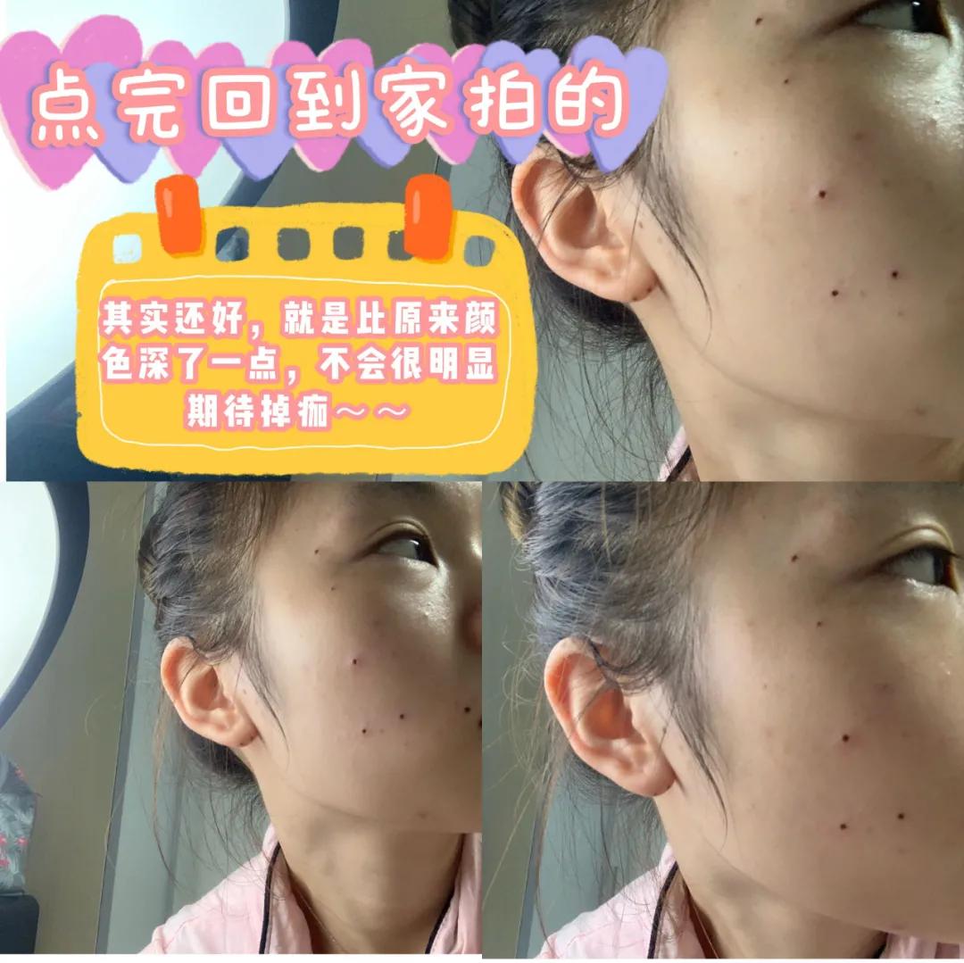 痣多适合什么点痣方法,点痣小妙招一秒点好一个美人痣