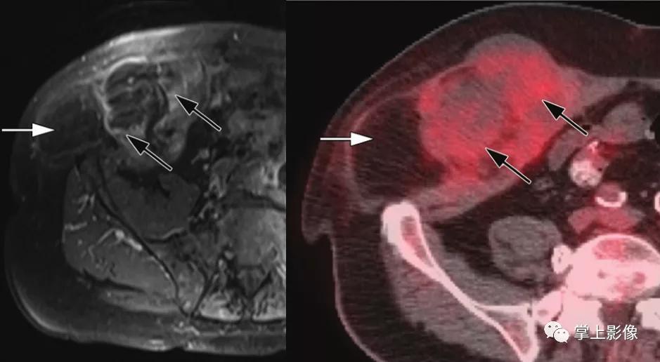 腹壁病变诊断思路,腹部影像诊断读片入门视频