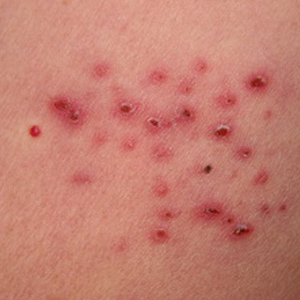 治疗带状疱疹用哪几种药配合最好,带状疱疹治疗方法及用药注意事项