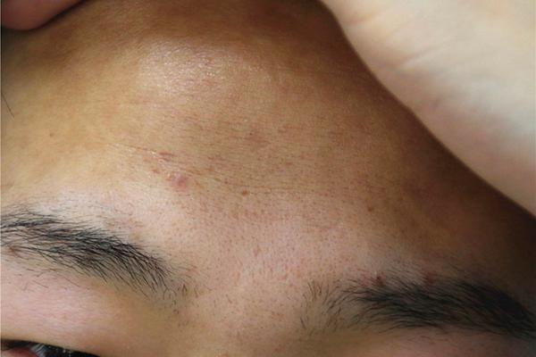 为什么会长痘痘痔疮,为什么会长痘痘还疼