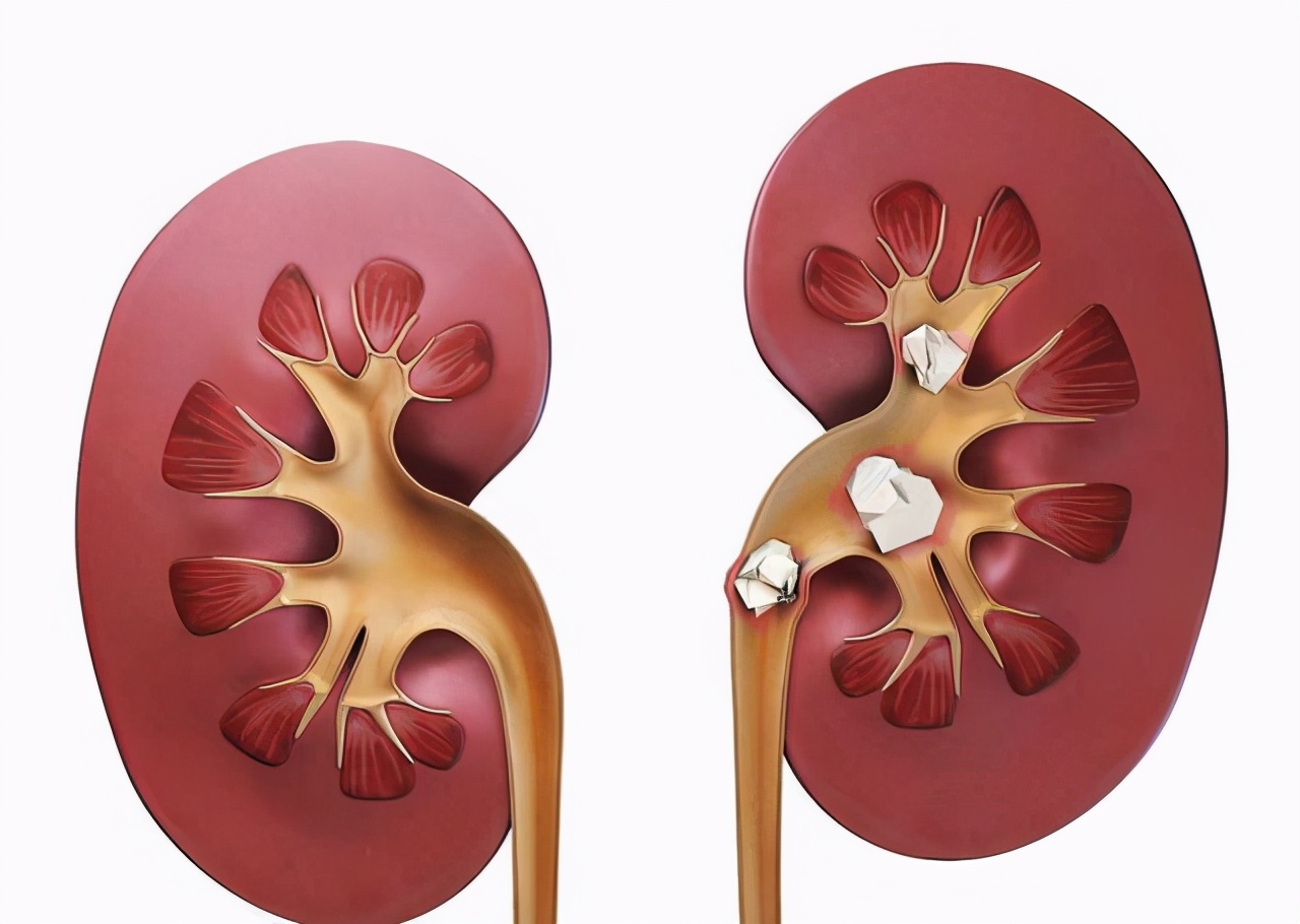 体外冲击波碎石取石术,体外冲击波碎石多少钱一次