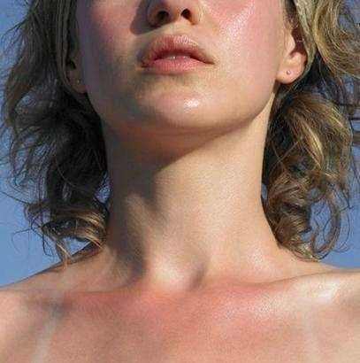 不小心晒伤怎么办?家居必备护理方法分享