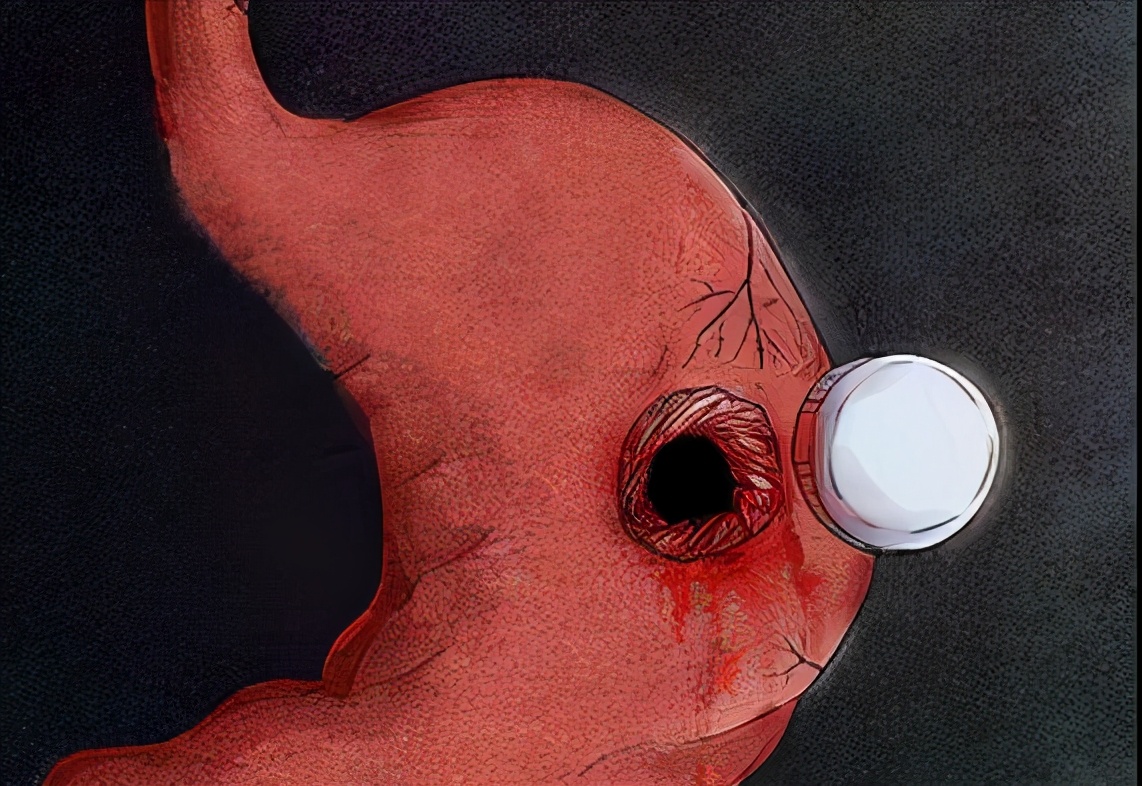 胃溃疡导致的后果有多严重,胃溃疡会造成什么后果