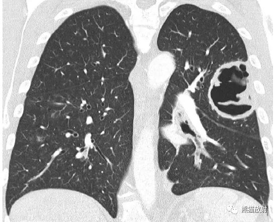 长期卧床病人肺部并发症,卧床患者肺部感染并发症