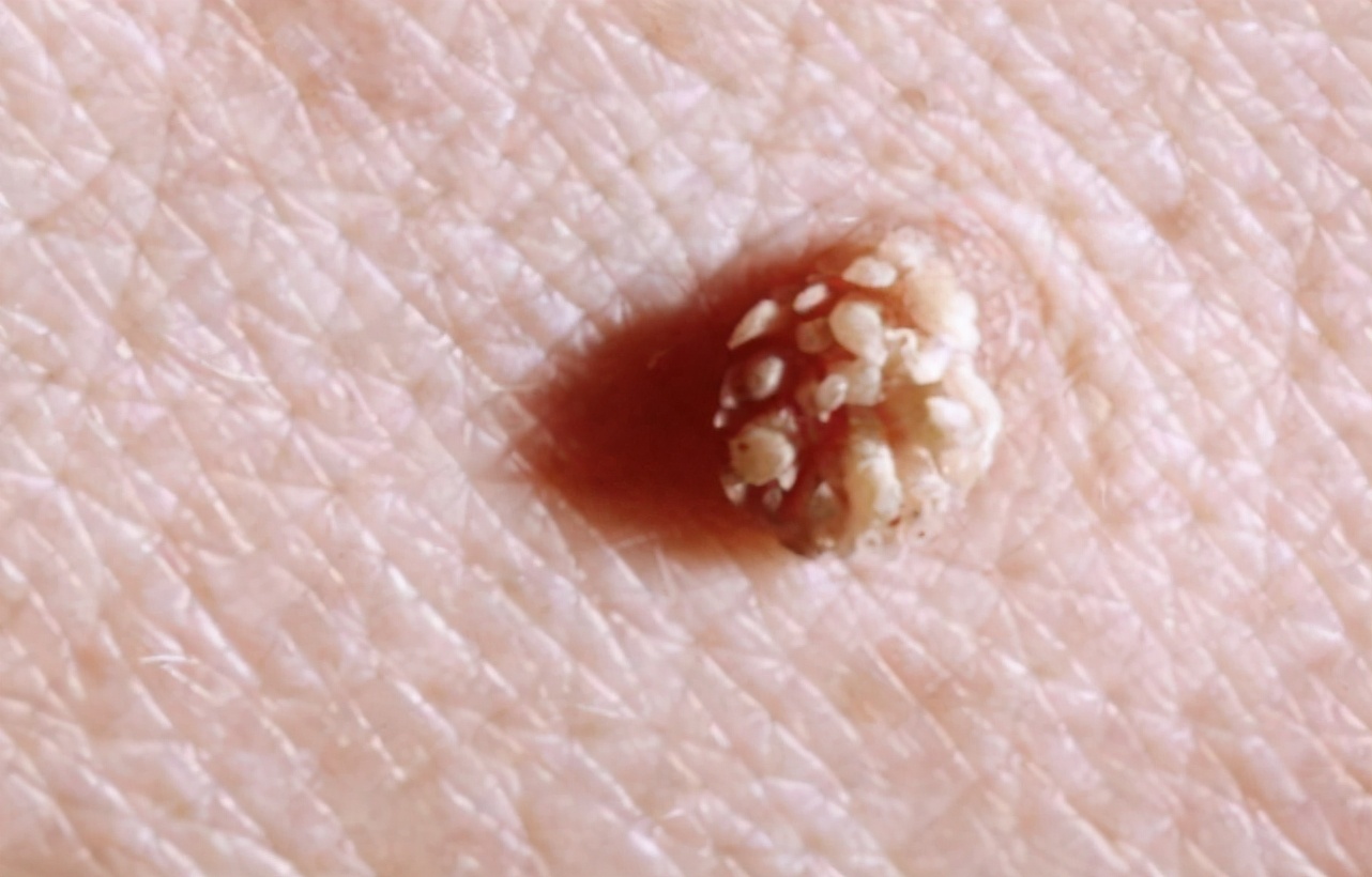 女性排便有粘液,排便有问题小心妇科疾病