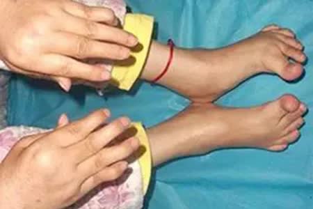 类风湿已经有了20年怎么治疗,类风湿症状越来越轻