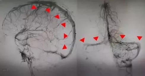 26岁小伙熬夜加班,23岁小伙熬夜突然头痛