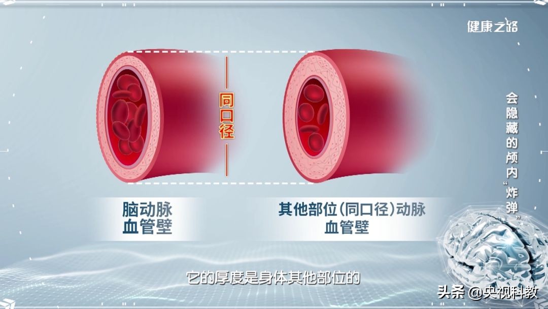 脑动脉瘤能吃腌制食品吗,过度食用腌制食品