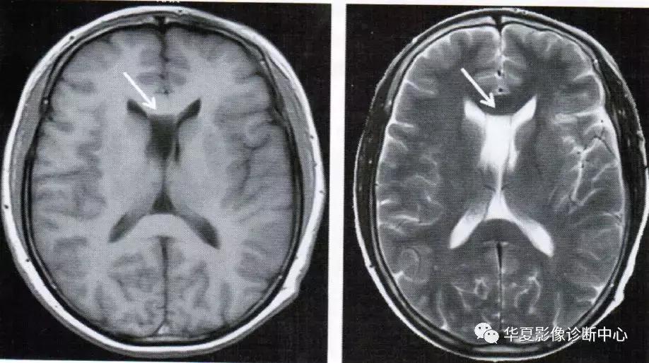 透明隔腔与透明囊肿鉴别,透明隔间腔与囊肿区别